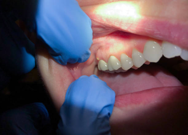 Best Emergency Treatment for Dental Infections or Abscesses in Glen Alpine, NC